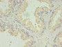 Immunohistochemistry of paraffin-embedded human prostate cancer using CAC11727 at dilution of 1:100