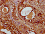IHC image of CAC11729 diluted at 1:400 and staining in paraffin-embedded human cervical cancer performed on a Leica BondTM system. After dewaxing and hydration, antigen retrieval was mediated by high pressure in a citrate buffer (pH 6.0). Section was blocked with 10% normal goat serum 30min at RT. Then primary antibody (1% BSA) was incubated at 4°C overnight. The primary is detected by a biotinylated secondary antibody and visualized using an HRP conjugated SP system.