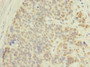 Immunohistochemistry of paraffin-embedded human gastric cancer using CAC11731 at dilution of 1:100