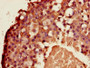 Immunohistochemistry of paraffin-embedded human breast cancer using CAC11742 at dilution of 1:100