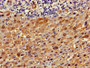Immunohistochemistry of paraffin-embedded human liver cancer using CAC11756 at dilution of 1:100