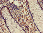 Immunohistochemistry of paraffin-embedded human colon cancer using CAC11757 at dilution of 1:100