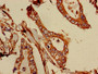 Immunohistochemistry of paraffin-embedded human pancreatic cancer using CAC11757 at dilution of 1:100