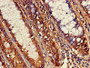 Immunohistochemistry of paraffin-embedded human colon cancer using CAC11759 at dilution of 1:100