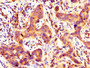 IHC image diluted at 1:400 and staining in paraffin-embedded human pancreatic cancer performed on a Leica BondTM system. After dewaxing and hydration, antigen retrieval was mediated by high pressure in a citrate buffer (pH 6.0). Section was blocked with 10% normal goat serum 30min at RT. Then primary antibody (1% BSA) was incubated at 4°C overnight. The primary is detected by a biotinylated secondary antibody and visualized using an HRP conjugated SP system.