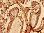 Immunohistochemistry analysis of human pancreatic cancer using CAC11766 at dilution of 1:100