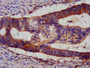 IHC image of CAC11767 diluted at 1:1200 and staining in paraffin-embedded human colon cancer performed on a Leica BondTM system. After dewaxing and hydration, antigen retrieval was mediated by high pressure in a citrate buffer (pH 6.0). Section was blocked with 10% normal goat serum 30min at RT. Then primary antibody (1% BSA) was incubated at 4°C overnight. The primary is detected by a biotinylated secondary antibody and visualized using an HRP conjugated SP system.