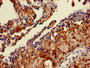 Immunohistochemistry of paraffin-embedded human lung cancer using CAC11783 at dilution of 1:100