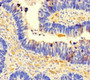 Immunohistochemistry of paraffin-embedded human ovarian cancer using CAC11786 at dilution of 1:100