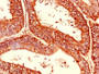 Immunohistochemistry of paraffin-embedded human endometrial cancer using CAC11792 at dilution of 1:100