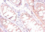 Immunohistochemistry of paraffin-embedded humancolon cancer using CAC11795 at dilution of 1:100