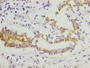 IHC image of CAC11810 diluted at 1:300 and staining in paraffin-embedded human breast cancer performed on a Leica BondTM system. After dewaxing and hydration, antigen retrieval was mediated by high pressure in a citrate buffer (pH 6.0). Section was blocked with 10% normal goat serum 30min at RT. Then primary antibody (1% BSA) was incubated at 4°C overnight. The primary is detected by a biotinylated secondary antibody and visualized using an HRP conjugated SP system.