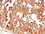 Immunohistochemistry of paraffin-embedded human breast cancer using CAC11811 at dilution of 1:100