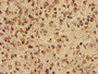 Immunohistochemistry of paraffin-embedded human glioma using CAC11812 at dilution of 1:100