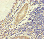 Immunohistochemistry of paraffin-embedded human colon cancer using CAC11821 at dilution of 1:100