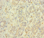 Immunohistochemistry of paraffin-embedded human pancreatic cancer using CAC11840 at dilution of 1:100