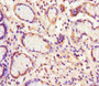 Immunohistochemistry of paraffin-embedded human gastric cancer using CAC11841 at dilution of 1:100