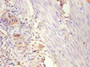 Immunohistochemistry of paraffin-embedded human breast cancer using CAC11846 at dilution of 1:100