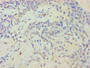 Immunohistochemistry of paraffin-embedded human breast cancer using CAC11848 at dilution of 1:100