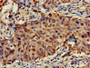 Immunohistochemistry of paraffin-embedded human lung cancer using CAC11852 at dilution of 1:100