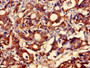 Immunohistochemistry of paraffin-embedded human gastric cancer using CAC11853 at dilution of 1:100