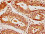 IHC image of CAC11860 diluted at 1:1000 and staining in paraffin-embedded human breast cancer performed on a Leica BondTM system. After dewaxing and hydration, antigen retrieval was mediated by high pressure in a citrate buffer (pH 6.0). Section was blocked with 10% normal goat serum 30min at RT. Then primary antibody (1% BSA) was incubated at 4°C overnight. The primary is detected by a biotinylated secondary antibody and visualized using an HRP conjugated SP system.