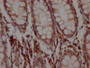 IHC image diluted at 1:100 and staining in paraffin-embedded human colon cancer performed on a Leica BondTM system. After dewaxing and hydration, antigen retrieval was mediated by high pressure in a citrate buffer (pH 6.0). Section was blocked with 10% normal goat serum 30min at RT. Then primary antibody (1% BSA) was incubated at 4? overnight. The primary is detected by a Goat anti-rabbit IgG polymer labeled by HRP and visualized using 0.05% DAB.