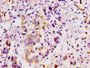 IHC image of CAC11917 diluted at 1:100 and staining in paraffin-embedded human breast cancer performed on a Leica BondTM system. After dewaxing and hydration, antigen retrieval was mediated by high pressure in a citrate buffer (pH 6.0). Section was blocked with 10% normal goat serum 30min at RT. Then primary antibody (1% BSA) was incubated at 4? overnight. The primary is detected by a biotinylated secondary antibody and visualized using an HRP conjugated SP system.