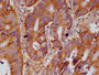 IHC image of CAC11959 diluted at 1:100 and staining in paraffin-embedded human colon cancer performed on a Leica BondTM system. After dewaxing and hydration, antigen retrieval was mediated by high pressure in a citrate buffer (pH 6.0). Section was blocked with 10% normal goat serum 30min at RT. Then primary antibody (1% BSA) was incubated at 4°C overnight. The primary is detected by a Goat anti-rabbit polymer IgG labeled by HRP and visualized using 0.05% DAB.