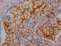 IHC image of CAC11960 diluted at 1:100 and staining in paraffin-embedded human lung tissue performed on a Leica BondTM system. After dewaxing and hydration, antigen retrieval was mediated by high pressure in a citrate buffer (pH 6.0). Section was blocked with 10% normal goat serum 30min at RT. Then primary antibody (1% BSA) was incubated at 4? overnight. The primary is detected by a Goat anti-rabbit IgG polymer labeled by HRP and visualized using 0.05% DAB.