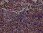 IHC image of CAC11962 diluted at 1:100 and staining in paraffin-embedded human lung cancer performed on a Leica BondTM system. After dewaxing and hydration, antigen retrieval was mediated by high pressure in a citrate buffer (pH 6.0). Section was blocked with 10% normal goat serum 30min at RT. Then primary antibody (1% BSA) was incubated at 4? overnight. The primary is detected by a Goat anti-rabbit IgG polymer labeled by HRP and visualized using 0.05% DAB.