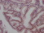 IHC image of CAC11987 diluted at 1:100 and staining in paraffin-embedded human prostate tissue performed on a Leica BondTM system. After dewaxing and hydration, antigen retrieval was mediated by high pressure in a citrate buffer (pH 6.0). Section was blocked with 10% normal goat serum 30min at RT. Then primary antibody (1% BSA) was incubated at 4? overnight. The primary is detected by a Goat anti-rabbit IgG polymer labeled by HRP and visualized using 0.05% DAB.
