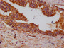 IHC image of CAC11990 diluted at 1:100 and staining in paraffin-embedded human prostate cancer performed on a Leica BondTM system. After dewaxing and hydration, antigen retrieval was mediated by high pressure in a citrate buffer (pH 6.0). Section was blocked with 10% normal goat serum 30min at RT. Then primary antibody (1% BSA) was incubated at 4°C overnight. The primary is detected by a Goat anti-rabbit polymer IgG labeled by HRP and visualized using 0.05% DAB.