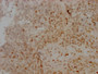 IHC image of CAC12010 diluted at 1:100 and staining in paraffin-embedded human cervical cancer performed on a Leica BondTM system. After dewaxing and hydration, antigen retrieval was mediated by high pressure in a citrate buffer (pH 6.0). Section was blocked with 10% normal goat serum 30min at RT. Then primary antibody (1% BSA) was incubated at 4? overnight. The primary is detected by a Goat anti-rabbit IgG polymer labeled by HRP and visualized using 0.05% DAB.