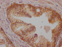 IHC image of CAC12012 diluted at 1:100 and staining in paraffin-embedded human prostate cancer performed on a Leica BondTM system. After dewaxing and hydration, antigen retrieval was mediated by high pressure in a citrate buffer (pH 6.0). Section was blocked with 10% normal goat serum 30min at RT. Then primary antibody (1% BSA) was incubated at 4? overnight. The primary is detected by a Goat anti-rabbit IgG polymer labeled by HRP and visualized using 0.05% DAB.