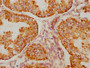 IHC image of CAC12015 diluted at 1:90 and staining in paraffin-embedded human endometrial cancer performed on a Leica BondTM system. After dewaxing and hydration, antigen retrieval was mediated by high pressure in a citrate buffer (pH 6.0). Section was blocked with 10% normal goat serum 30min at RT. Then primary antibody (1% BSA) was incubated at 4? overnight. The primary is detected by a biotinylated secondary antibody and visualized using an HRP conjugated SP system.