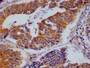 IHC image of CAC12017 diluted at 1:100 and staining in paraffin-embedded human colon cancer performed on a Leica BondTM system. After dewaxing and hydration, antigen retrieval was mediated by high pressure in a citrate buffer (pH 6.0). Section was blocked with 10% normal goat serum 30min at RT. Then primary antibody (1% BSA) was incubated at 4°C overnight. The primary is detected by a Goat anti-rabbit polymer IgG labeled by HRP and visualized using 0.05% DAB.