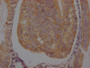 IHC image of CAC12023 diluted at 1:100 and staining in paraffin-embedded human endometrial cancer performed on a Leica BondTM system. After dewaxing and hydration, antigen retrieval was mediated by high pressure in a citrate buffer (pH 6.0). Section was blocked with 10% normal goat serum 30min at RT. Then primary antibody (1% BSA) was incubated at 4? overnight. The primary is detected by a Goat anti-rabbit IgG polymer labeled by HRP and visualized using 0.05% DAB.