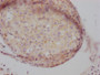 IHC image of CAC12024 diluted at 1:100 and staining in paraffin-embedded human breast cancer performed on a Leica BondTM system. After dewaxing and hydration, antigen retrieval was mediated by high pressure in a citrate buffer (pH 6.0). Section was blocked with 10% normal goat serum 30min at RT. Then primary antibody (1% BSA) was incubated at 4? overnight. The primary is detected by a Goat anti-rabbit IgG polymer labeled by HRP and visualized using 0.05% DAB.