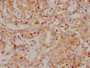 IHC image of CAC12037 diluted at 1:118 and staining in paraffin-embedded human liver cancer performed on a Leica BondTM system. After dewaxing and hydration, antigen retrieval was mediated by high pressure in a citrate buffer (pH 6.0). Section was blocked with 10% normal goat serum 30min at RT. Then primary antibody (1% BSA) was incubated at 4? overnight. The primary is detected by a biotinylated secondary antibody and visualized using an HRP conjugated SP system.