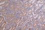 IHC image of CAC12040 diluted at 1:100 and staining in paraffin-embedded human breast cancer performed on a Leica BondTM system. After dewaxing and hydration, antigen retrieval was mediated by high pressure in a citrate buffer (pH 6.0). Section was blocked with 10% normal goat serum 30min at RT. Then primary antibody (1% BSA) was incubated at 4°C overnight. The primary is detected by a Goat anti-rabbit polymer IgG labeled by HRP and visualized using 0.18% DAB.