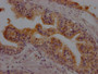 IHC image of CAC12058 diluted at 1:100 and staining in paraffin-embedded human prostate cancer performed on a Leica BondTM system. After dewaxing and hydration, antigen retrieval was mediated by high pressure in a citrate buffer (pH 6.0). Section was blocked with 10% normal goat serum 30min at RT. Then primary antibody (1% BSA) was incubated at 4? overnight. The primary is detected by a Goat anti-rabbit IgG polymer labeled by HRP and visualized using 0.05% DAB.