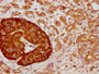 IHC image of CAC12070 diluted at 1:155 and staining in paraffin-embedded human pancreatic cancer performed on a Leica BondTM system. After dewaxing and hydration, antigen retrieval was mediated by high pressure in a citrate buffer (pH 6.0). Section was blocked with 10% normal goat serum 30min at RT. Then primary antibody (1% BSA) was incubated at 4? overnight. The primary is detected by a biotinylated secondary antibody and visualized using an HRP conjugated SP system.