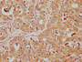 IHC image of CAC12070 diluted at 1:155 and staining in paraffin-embedded human liver cancer performed on a Leica BondTM system. After dewaxing and hydration, antigen retrieval was mediated by high pressure in a citrate buffer (pH 6.0). Section was blocked with 10% normal goat serum 30min at RT. Then primary antibody (1% BSA) was incubated at 4? overnight. The primary is detected by a biotinylated secondary antibody and visualized using an HRP conjugated SP system.