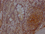 IHC image of CAC12071 diluted at 1:100 and staining in paraffin-embedded human colon cancer performed on a Leica BondTM system. After dewaxing and hydration, antigen retrieval was mediated by high pressure in a citrate buffer (pH 6.0). Section was blocked with 10% normal goat serum 30min at RT. Then primary antibody (1% BSA) was incubated at 4? overnight. The primary is detected by a Goat anti-rabbit IgG polymer labeled by HRP and visualized using 0.05% DAB.