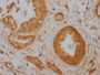 IHC image of CAC12076 diluted at 1:100 and staining in paraffin-embedded human pancreatic cancer performed on a Leica BondTM system. After dewaxing and hydration, antigen retrieval was mediated by high pressure in a citrate buffer (pH 6.0). Section was blocked with 10% normal goat serum 30min at RT. Then primary antibody (1% BSA) was incubated at 4? overnight. The primary is detected by a Goat anti-rabbit IgG polymer labeled by HRP and visualized using 0.05% DAB.