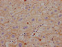 IHC image of CAC12084 diluted at 1:100 and staining in paraffin-embedded human liver cancer performed on a Leica BondTM system. After dewaxing and hydration, antigen retrieval was mediated by high pressure in a citrate buffer (pH 6.0). Section was blocked with 10% normal goat serum 30min at RT. Then primary antibody (1% BSA) was incubated at 4? overnight. The primary is detected by a Goat anti-rabbit IgG polymer labeled by HRP and visualized using 0.05% DAB.