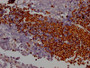IHC image of CAC12094 diluted at 1:100 and staining in paraffin-embedded human lung cancer performed on a Leica BondTM system. After dewaxing and hydration, antigen retrieval was mediated by high pressure in a citrate buffer (pH 6.0). Section was blocked with 10% normal goat serum 30min at RT. Then primary antibody (1% BSA) was incubated at 4? overnight. The primary is detected by a Goat anti-rabbit IgG polymer labeled by HRP and visualized using 0.05% DAB.