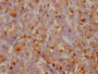 IHC image of CAC12095 diluted at 1:100 and staining in paraffin-embedded human breast cancer performed on a Leica BondTM system. After dewaxing and hydration, antigen retrieval was mediated by high pressure in a citrate buffer (pH 6.0). Section was blocked with 10% normal goat serum 30min at RT. Then primary antibody (1% BSA) was incubated at 4? overnight. The primary is detected by a Goat anti-rabbit IgG polymer labeled by HRP and visualized using 0.05% DAB.