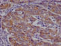 IHC image of CAC12109 diluted at 1:100 and staining in paraffin-embedded human colon cancer performed on a Leica BondTM system. After dewaxing and hydration, antigen retrieval was mediated by high pressure in a citrate buffer (pH 6.0). Section was blocked with 10% normal goat serum 30min at RT. Then primary antibody (1% BSA) was incubated at 4°C overnight. The primary is detected by a Goat anti-rabbit polymer IgG labeled by HRP and visualized using 0.05% DAB.